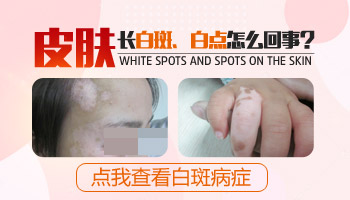 24岁女性腿部长块白斑是什么