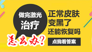 308激光治疗白癜风后变黑皮肤会恢复吗