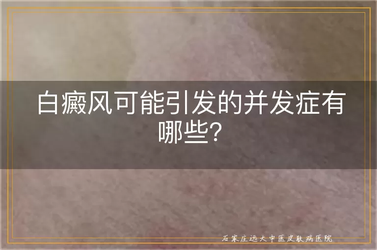 白癜风可能引发的并发症有哪些？