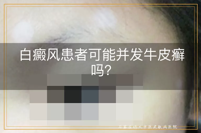 白癜风患者可能并发牛皮癣吗？