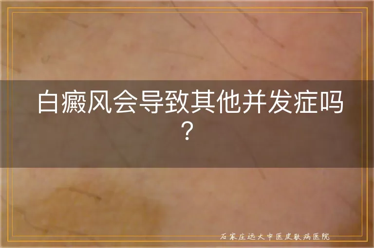 白癜风会导致其他并发症吗？