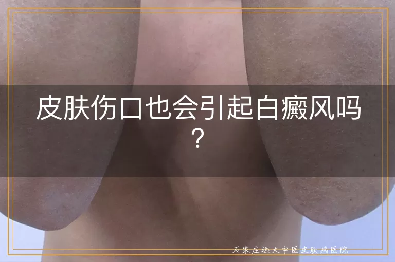 皮肤伤口也会引起白癜风吗？