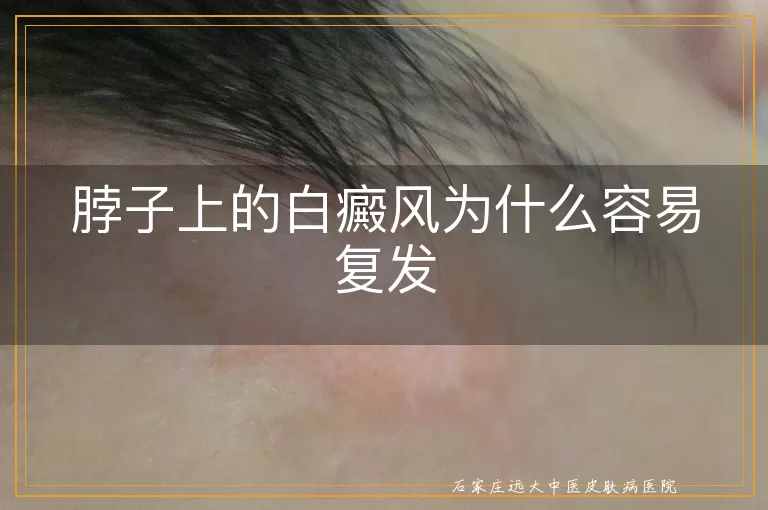 脖子上的白癜风为什么容易复发