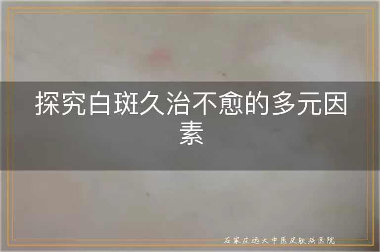 探究白斑久治不愈的多元因素