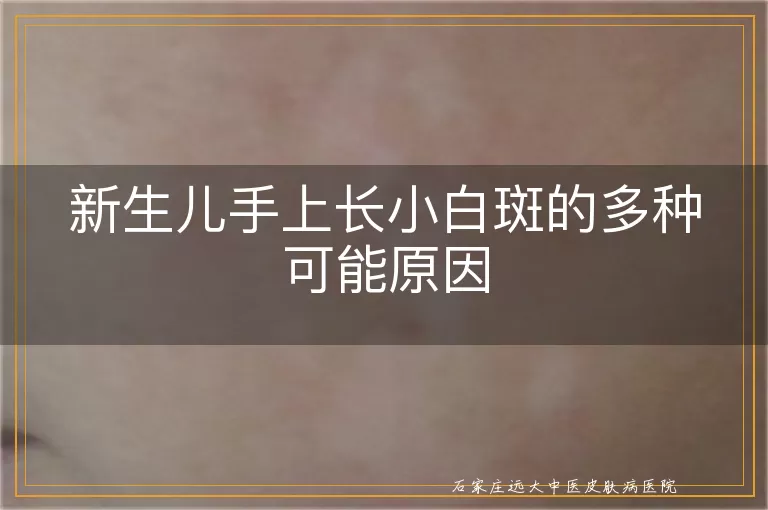 新生儿手上长小白斑的多种可能原因