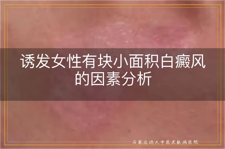 诱发女性有块小面积白癜风的因素分析