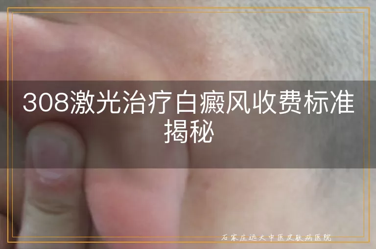 308激光治疗白癜风收费标准揭秘