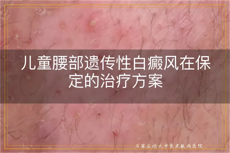 儿童腰部遗传性白癜风在保定的治疗方案