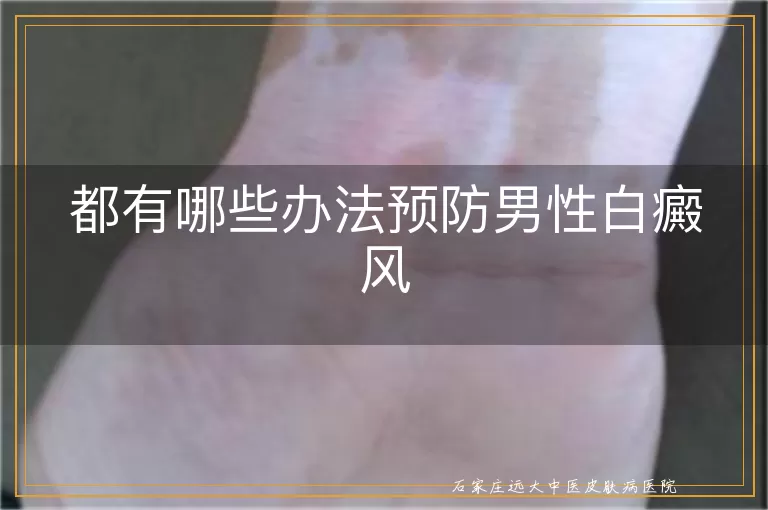 都有哪些办法预防男性白癜风