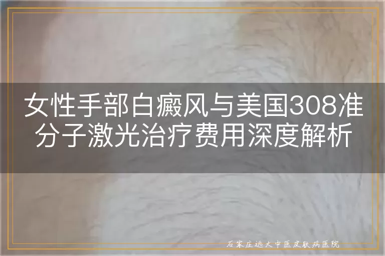 女性手部白癜风与美国308准分子激光治疗费用深度解析