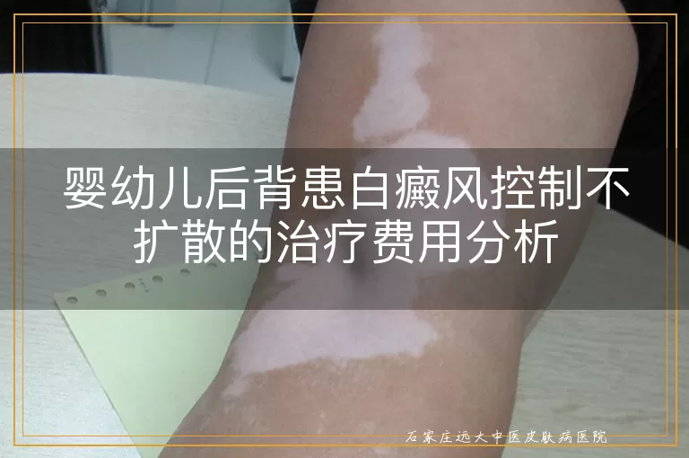 婴幼儿后背患白癜风控制不扩散的治疗费用分析