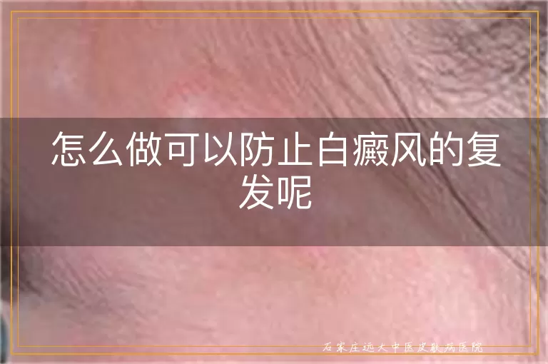 怎么做可以防止白癜风的复发呢