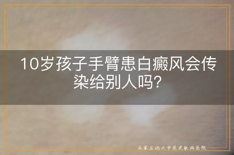 10岁孩子手臂患白癜风会传染给别人吗？