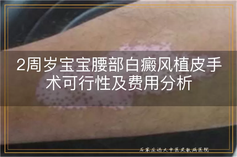 2周岁宝宝腰部白癜风植皮手术可行性及费用分析