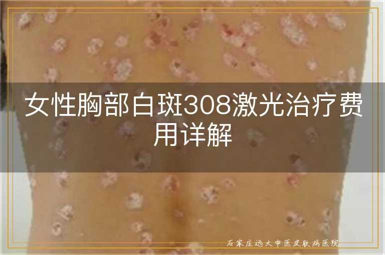 女性胸部白斑308激光治疗费用详解