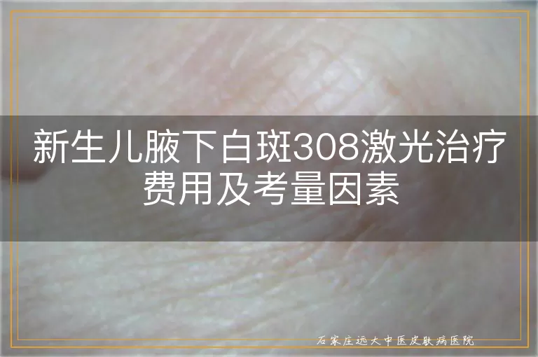 新生儿腋下白斑308激光治疗费用及考量因素