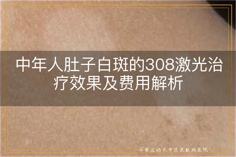 中年人肚子白斑的308激光治疗效果及费用解析