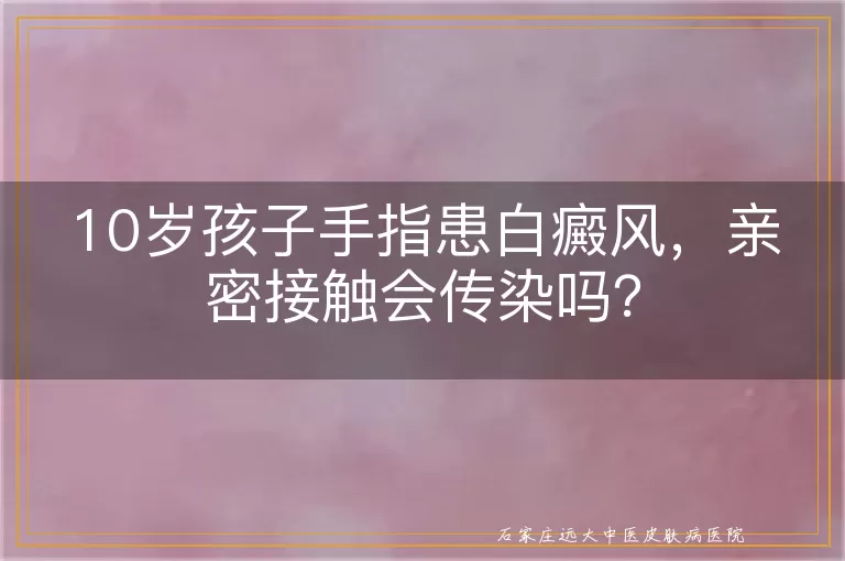 10岁孩子手指患白癜风，亲密接触会传染吗？