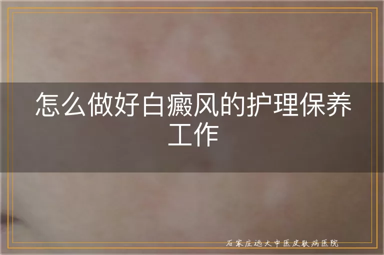 怎么做好白癜风的护理保养工作