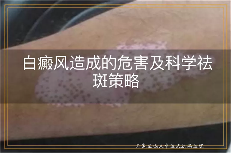 白癜风造成的危害及科学祛斑策略