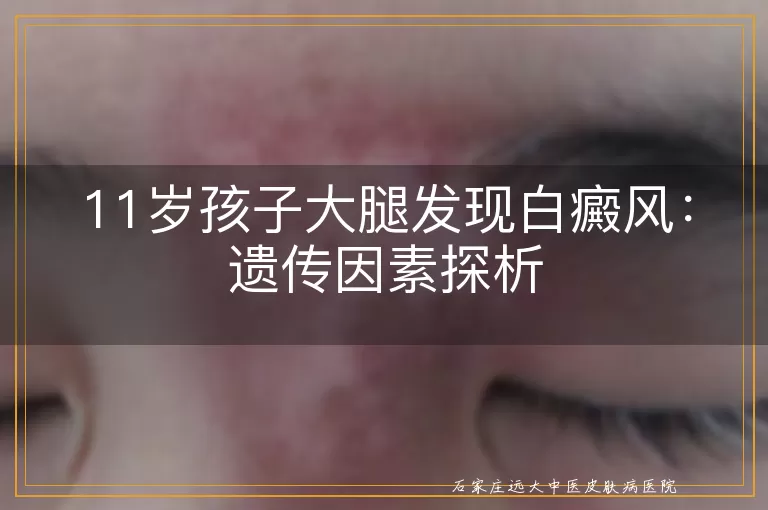 11岁孩子大腿发现白癜风：遗传因素探析