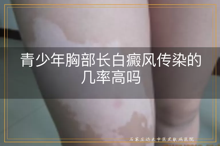 青少年胸部长白癜风传染的几率高吗