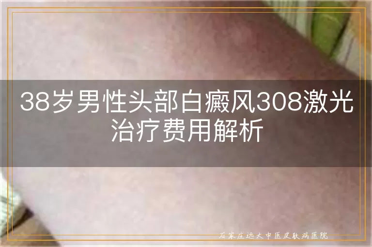 38岁男性头部白癜风308激光治疗费用解析