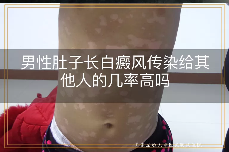 男性肚子长白癜风传染给其他人的几率高吗