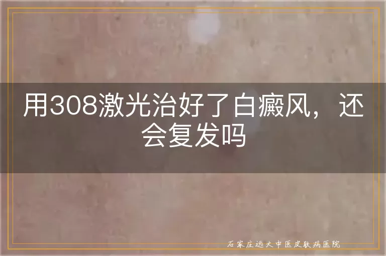 用308激光治好了白癜风，还会复发吗