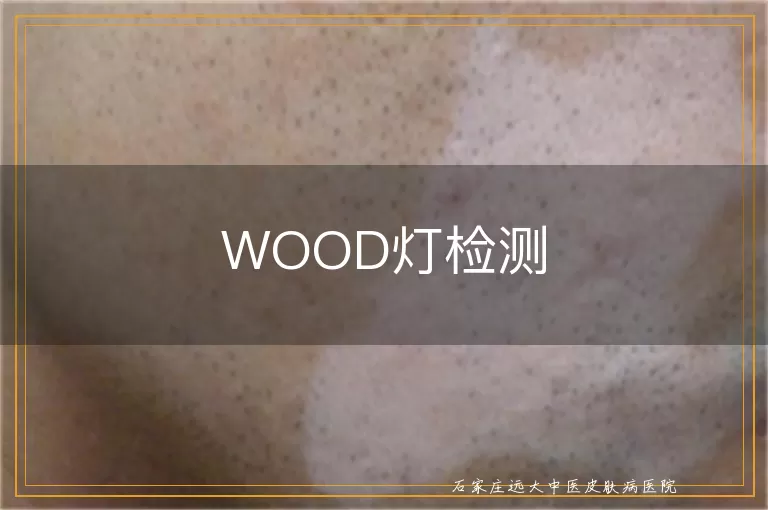 WOOD灯检测