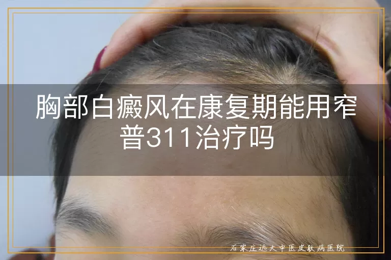 胸部白癜风在康复期能用窄普311治疗吗