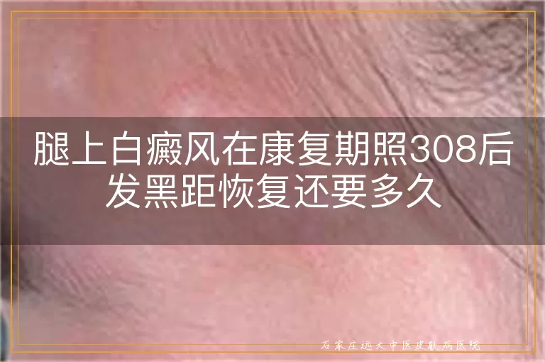 腿上白癜风在康复期照308后发黑距恢复还要多久