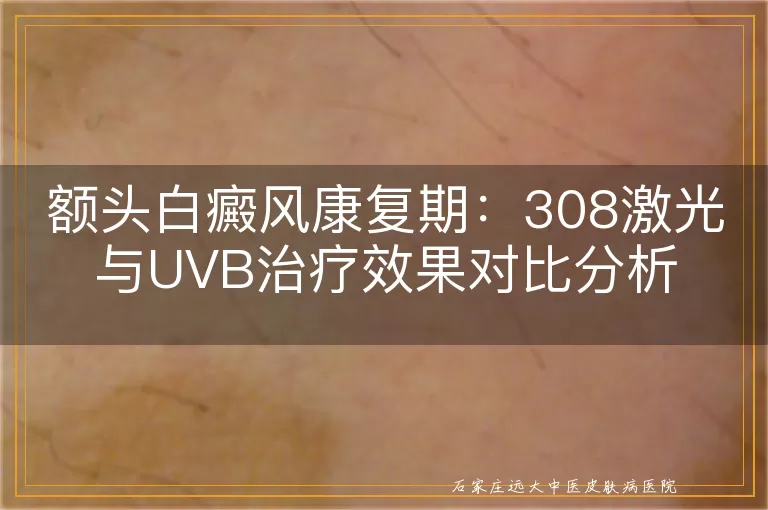 额头白癜风康复期：308激光与UVB治疗效果对比分析