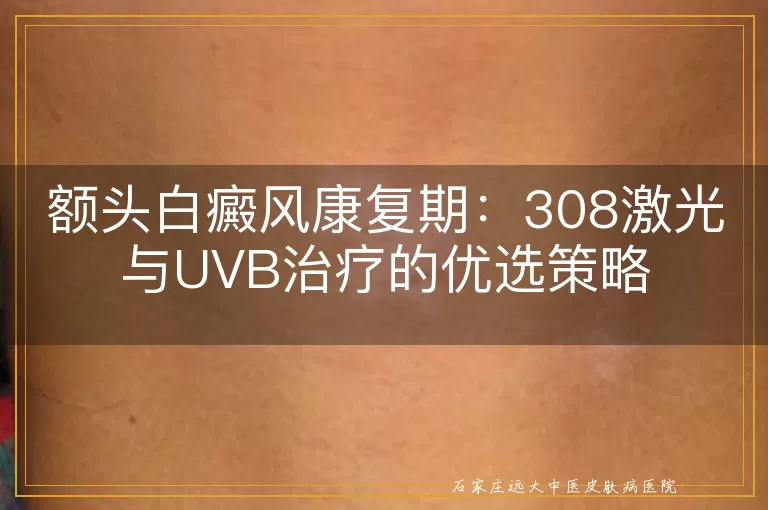 额头白癜风康复期：308激光与UVB治疗的优选策略