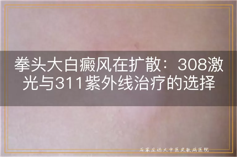 拳头大白癜风在扩散：308激光与311紫外线治疗的选择