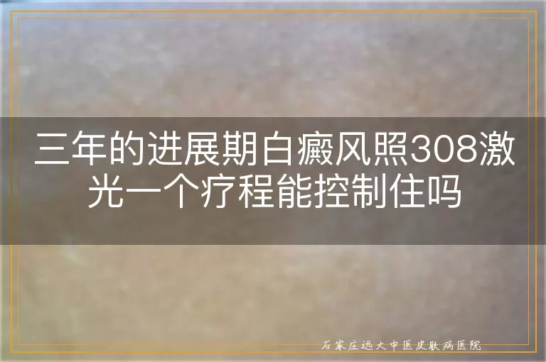 三年的进展期白癜风照308激光一个疗程能控制住吗