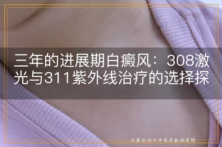 三年的进展期白癜风：308激光与311紫外线治疗的选择探讨