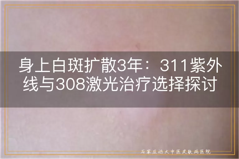 身上白斑扩散3年：311紫外线与308激光治疗选择探讨