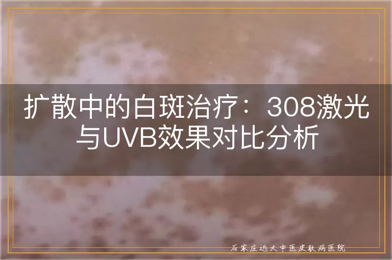 扩散中的白斑治疗：308激光与UVB效果对比分析