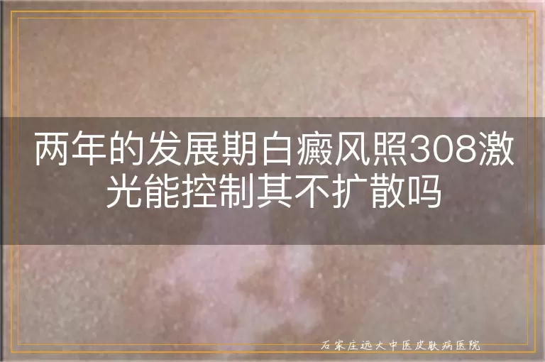 两年的发展期白癜风照308激光能控制其不扩散吗