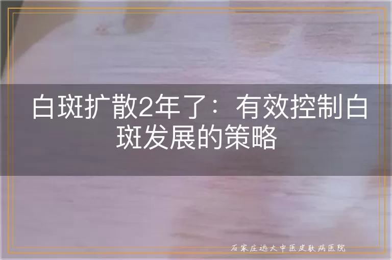 白斑扩散2年了：有效控制白斑发展的策略