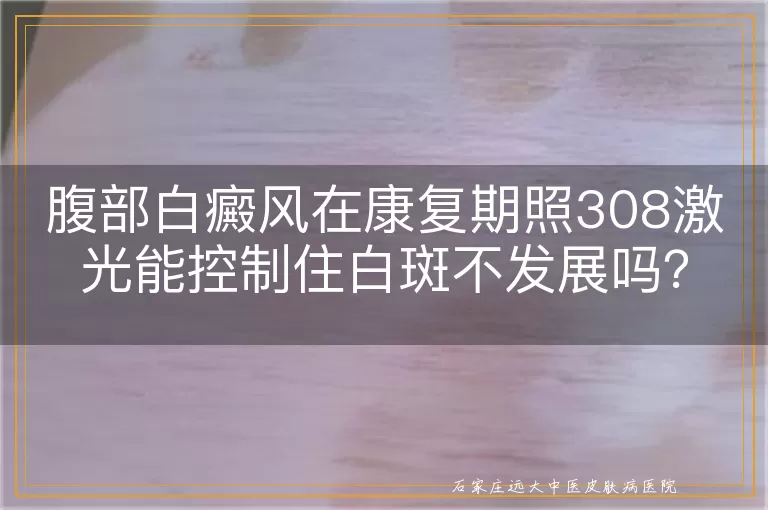 腹部白癜风在康复期照308激光能控制住白斑不发展吗？