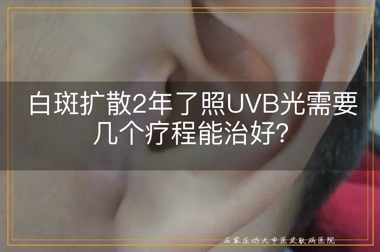 白斑扩散2年了照UVB光需要几个疗程能治好？