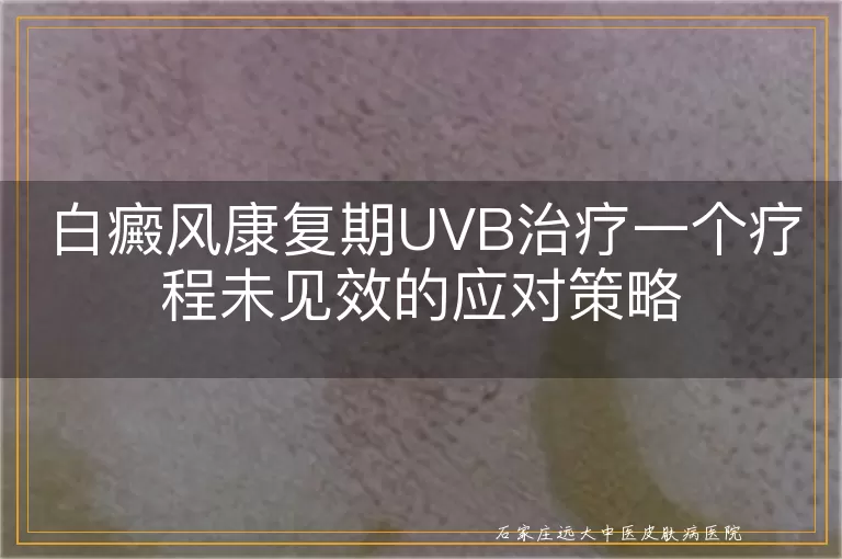 白癜风康复期UVB治疗一个疗程未见效的应对策略