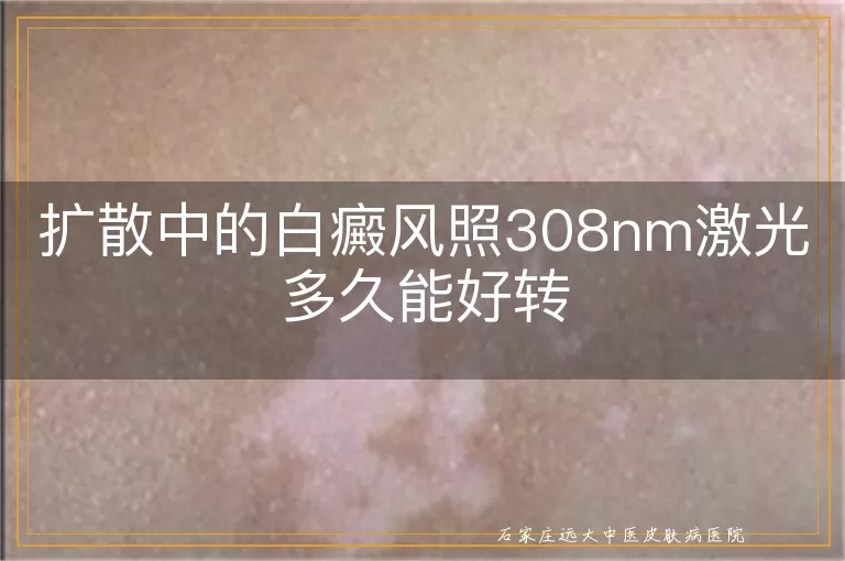 扩散中的白癜风照308nm激光多久能好转