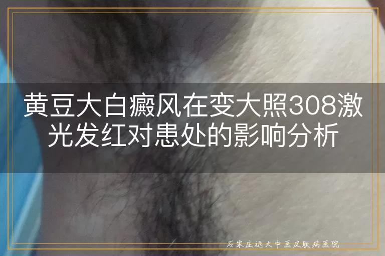 黄豆大白癜风在变大照308激光发红对患处的影响分析