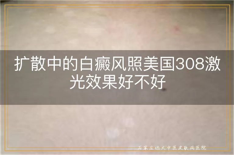 扩散中的白癜风照美国308激光效果好不好