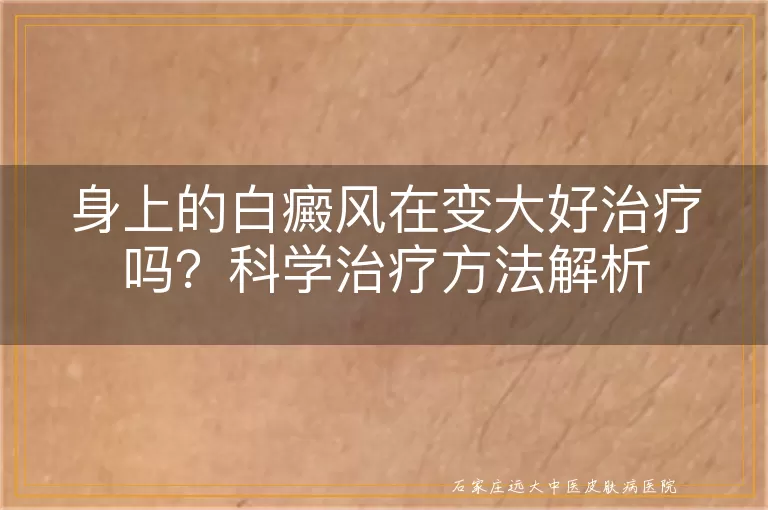 身上的白癜风在变大好治疗吗？科学治疗方法解析