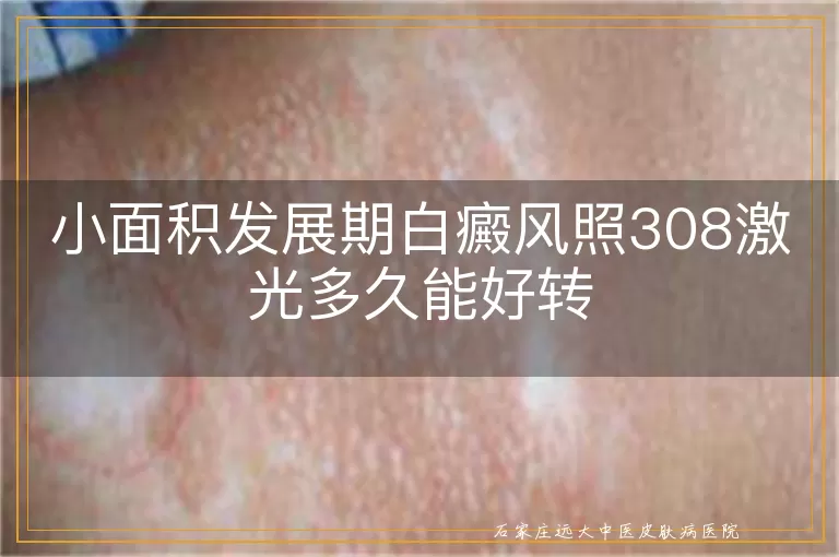 小面积发展期白癜风照308激光多久能好转