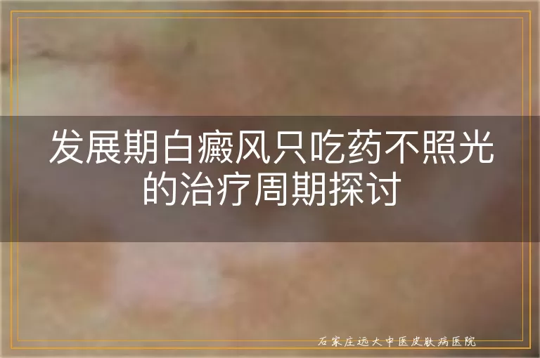 发展期白癜风只吃药不照光的治疗周期探讨